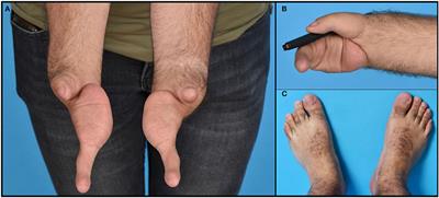 Peripheral Nerve Innervation in Bilateral Cleft Hand Syndrome Elucidated by Ultrasound